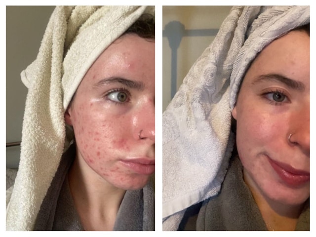 Acne Skin Repair Treatment, Acne scar repair Magherafelt Mid-Ulster