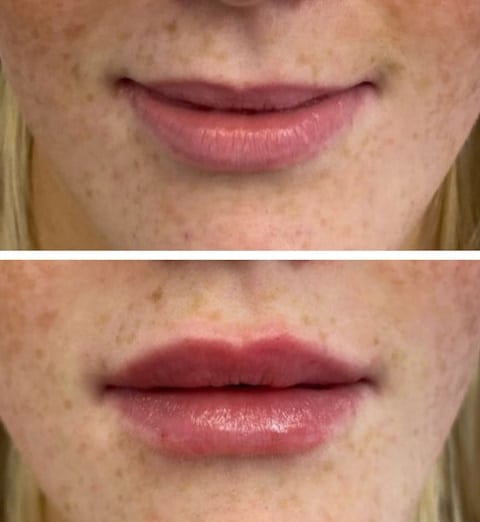 Dermal Filler, Lip Filler, Cheek Filler, Facial Filler - CP Medical Aesthetics Magherafelt Mid-Ulster Northern Ireland